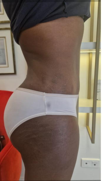Nach der Abdominoplastik, Fall 6