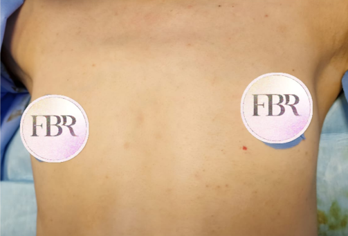 Vor der Brustvergrößerung mit Implantat