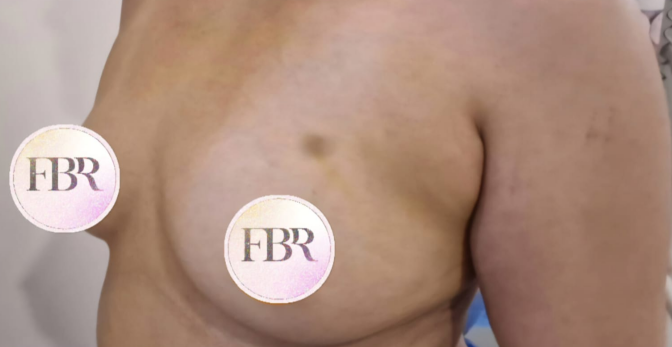 Vor der Brustvergrößerung mit Implantat