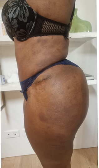 After tummy tuck — case 4