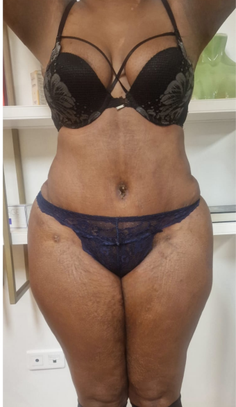 After tummy tuck — case 5