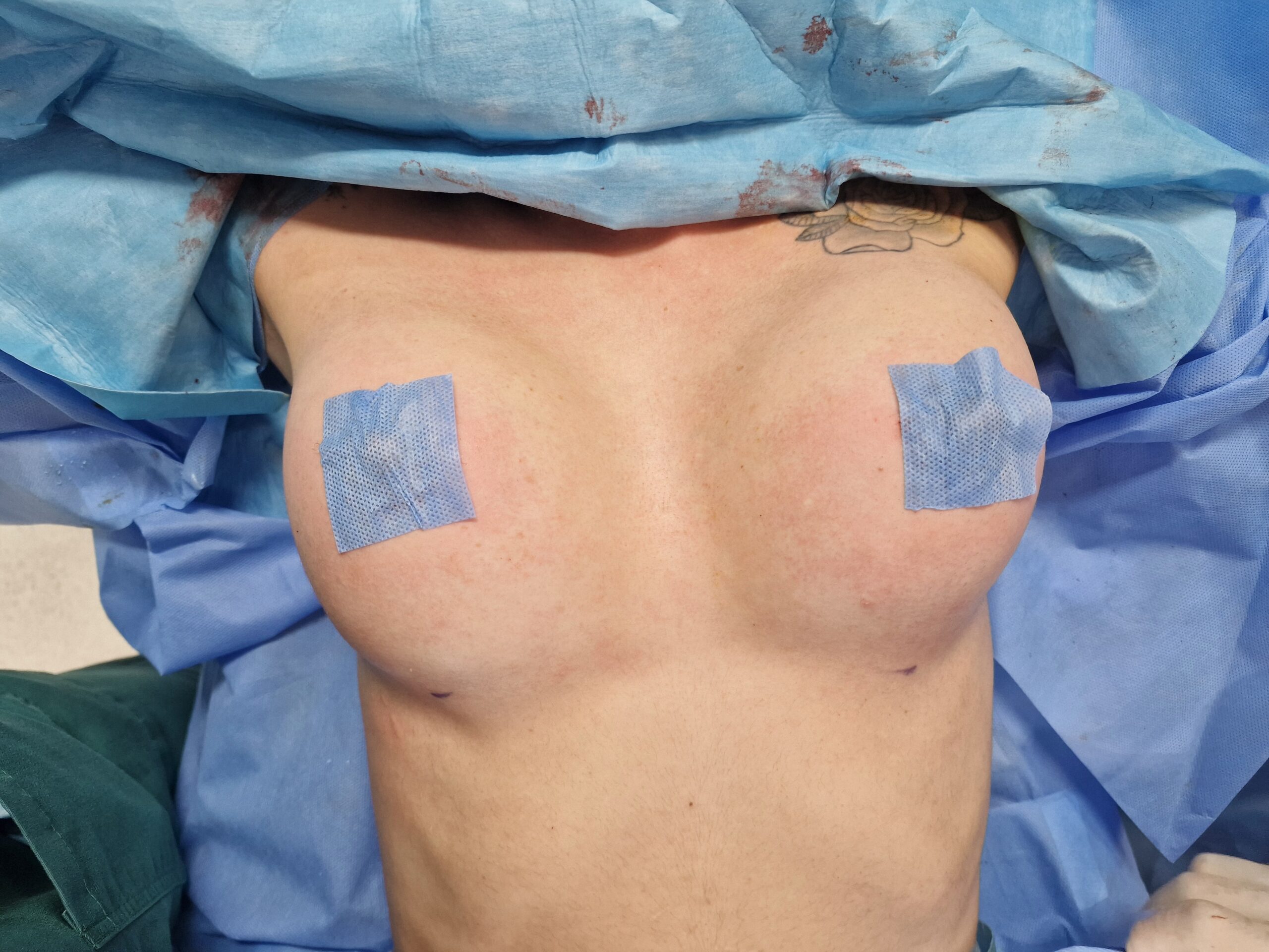 After breast lipofilling — post-operative result