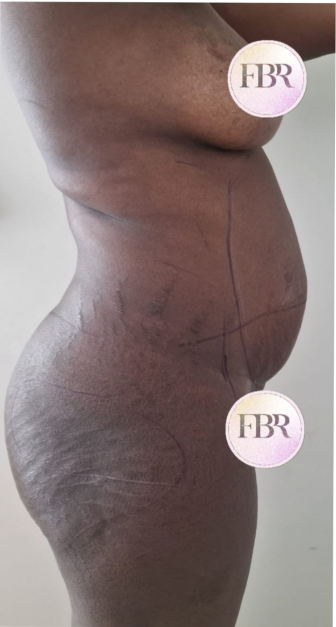 Antes de la abdominoplastia, caso 6