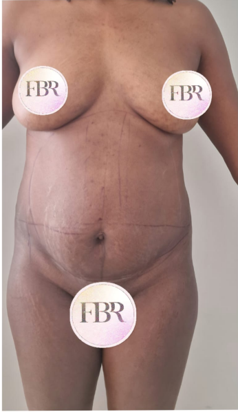 Antes de la abdominoplastia, caso 7