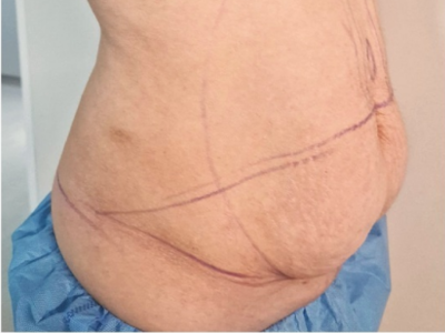 Antes de la abdominoplastia