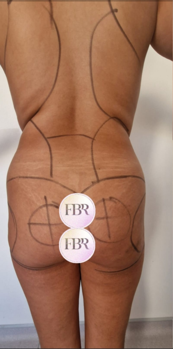 Antes del lipofilling de glúteos, caso 2