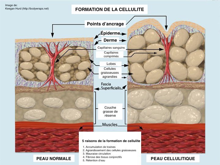 Schéma pédagogique des facteurs de l'aspect en capitons de la cellulite