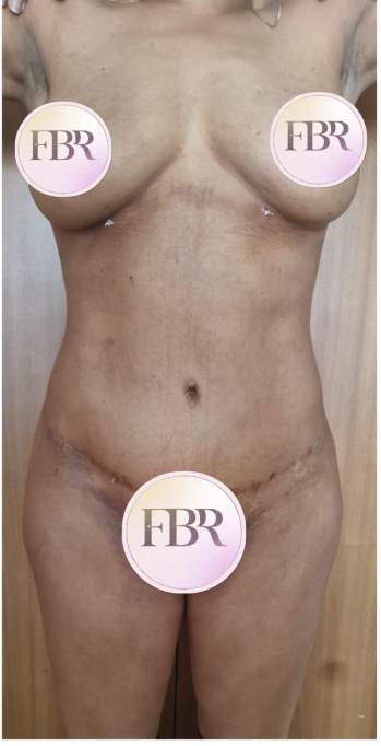 Après abdominoplastie, cas 2