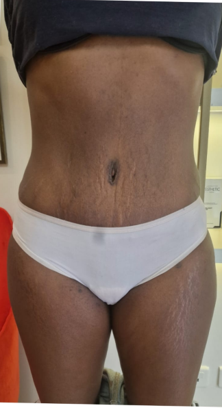 Après abdominoplastie, cas 7