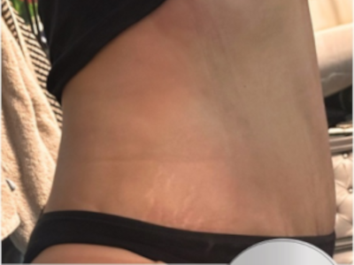 Après abdominoplastie