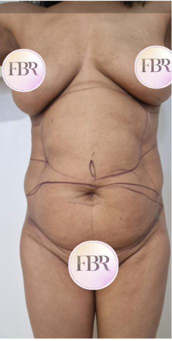 Avant abdominoplastie, cas 2