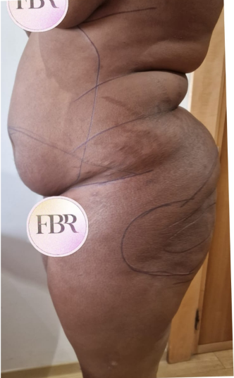 Avant abdominoplastie, cas 4