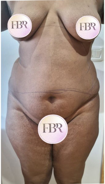 Avant abdominoplastie, cas 5