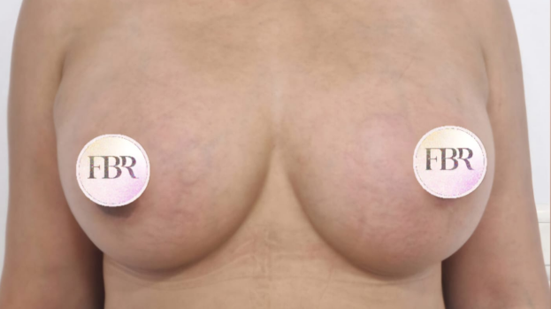 Après l'augmentation mammaire par prothèse