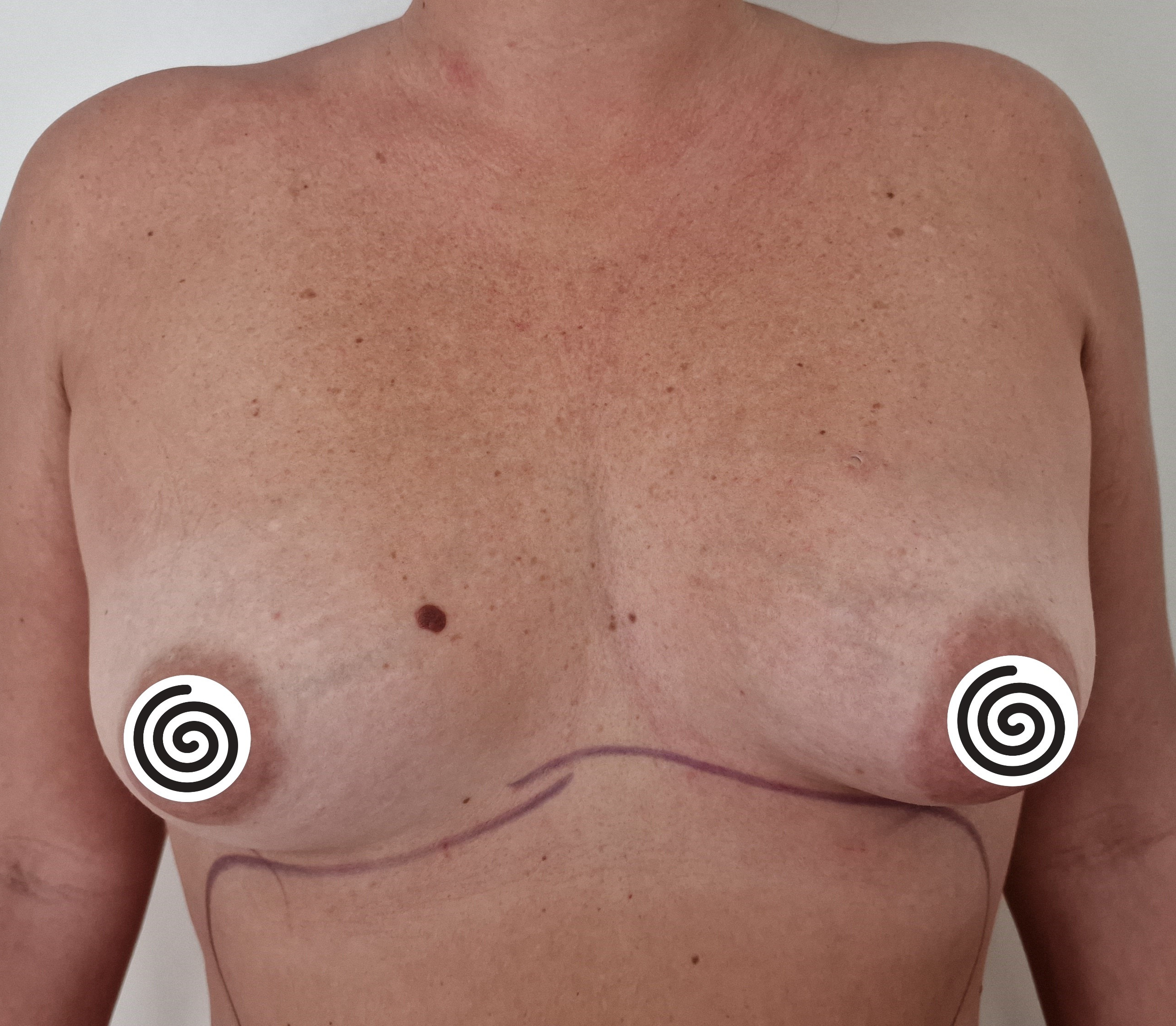 Avant augmentation mammaire, cas 2