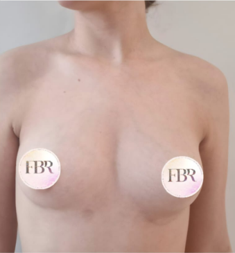 Avant l'augmentation mammaire par prothèse