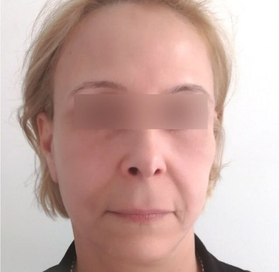 Après blépharoplastie
