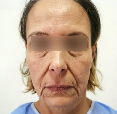 Avant blépharoplastie