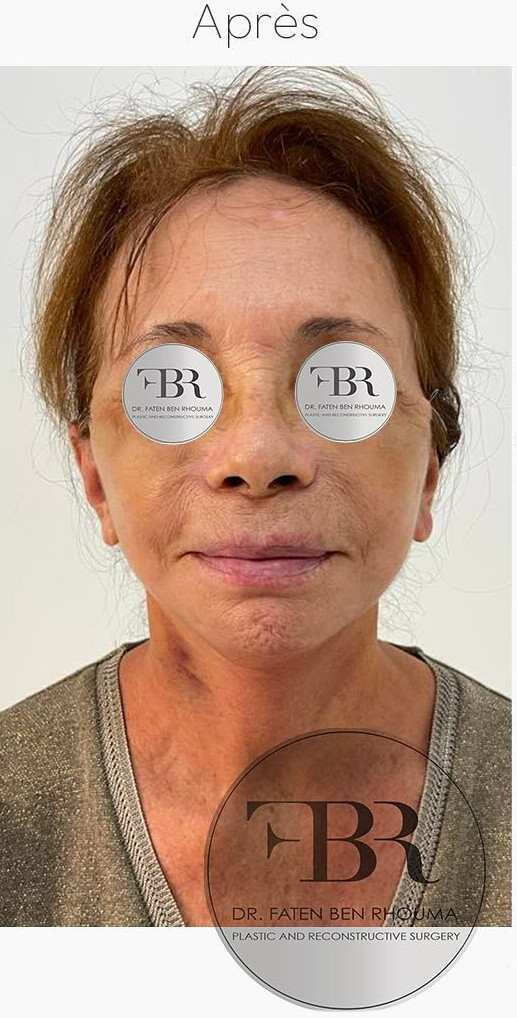 Après lifting du visage