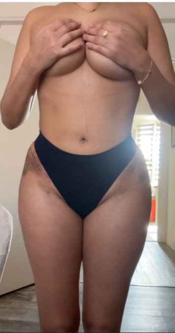 Après lipofilling des fesses — cas 3
