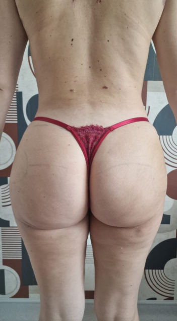 Après lipofilling des fesses — cas 5