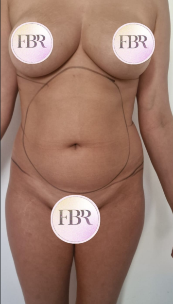 Avant lipofilling des fesses — cas 3