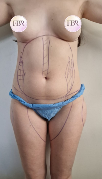 Avant lipofilling des fesses — cas 4