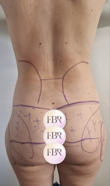 Avant lipofilling des fesses — cas 5