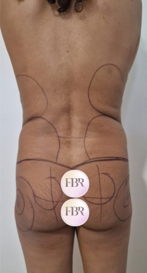 Avant lipofilling des fesses — cas 7