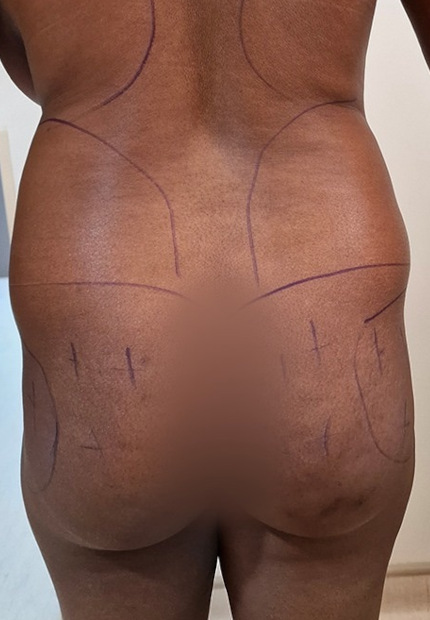 Avant lipofilling des fesses