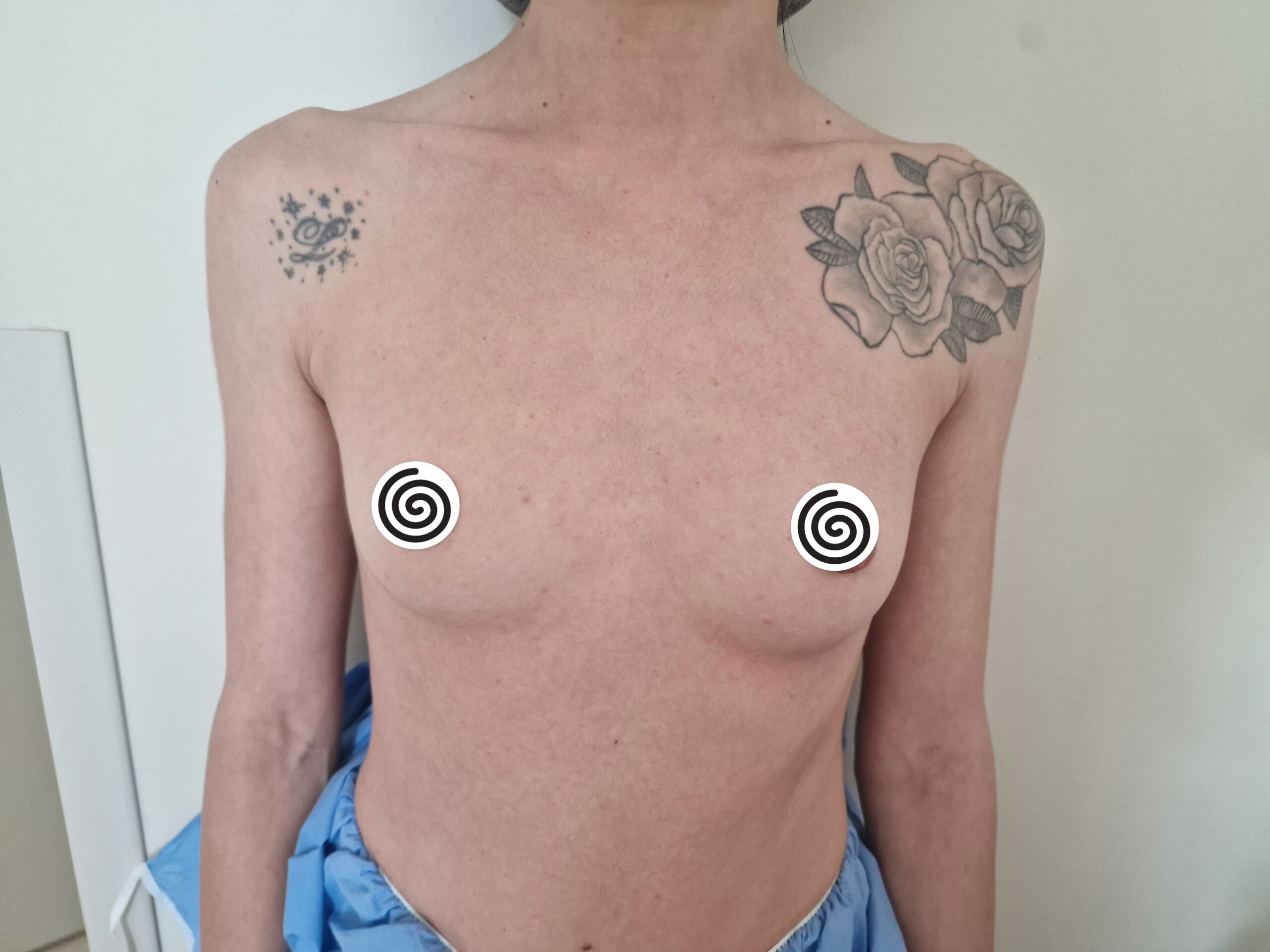 Avant lipofilling mammaire — état initial des seins