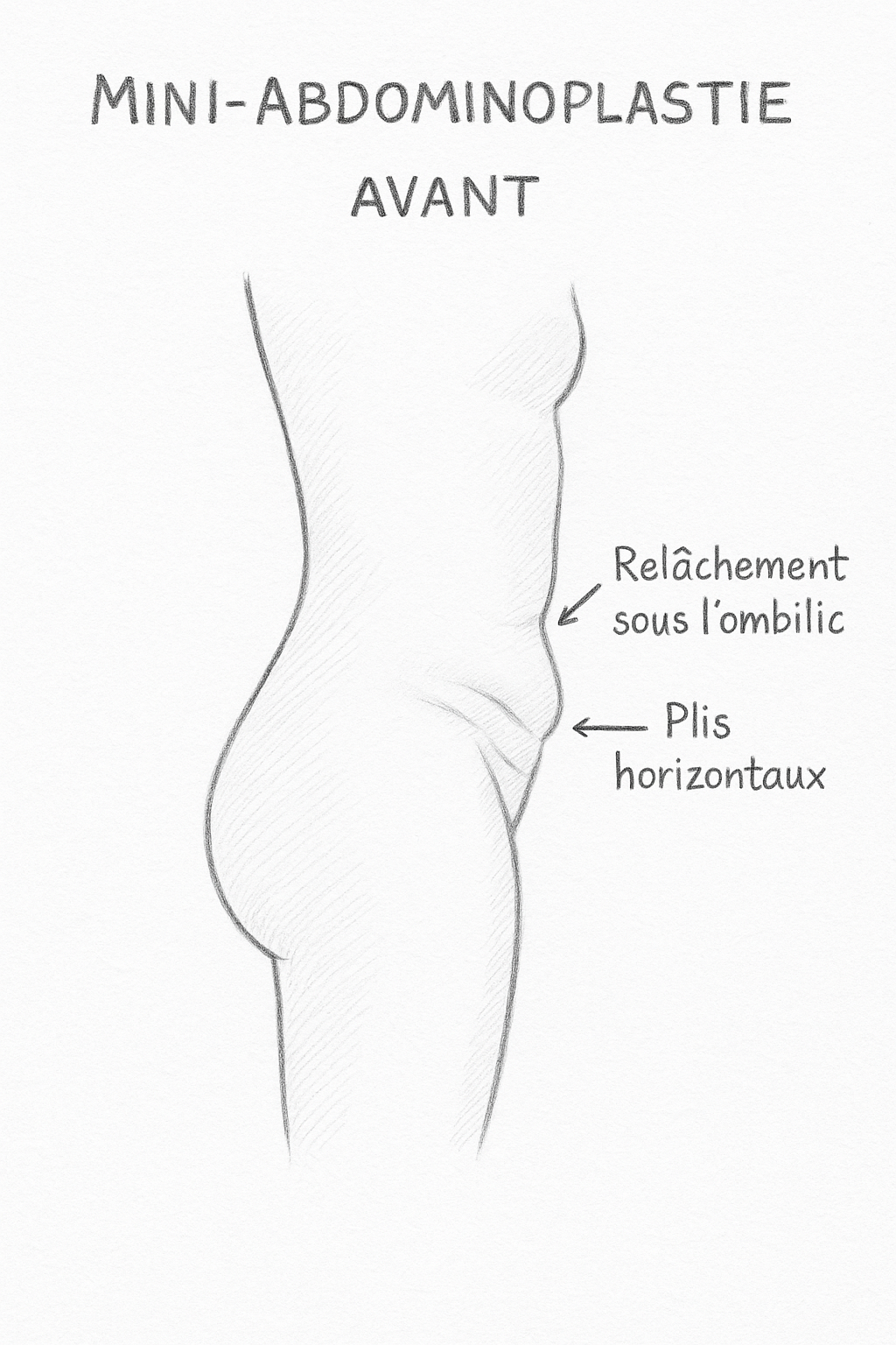 Avant mini-abdominoplastie