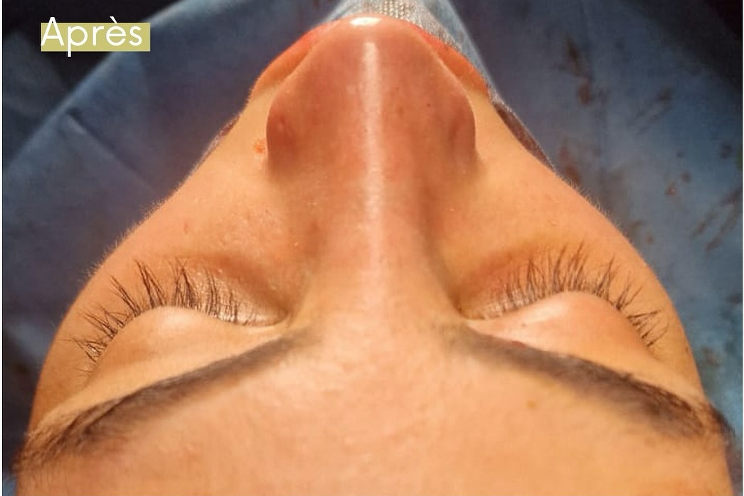 Après rhinoplastie