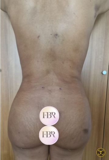 Dopo il lipofilling dei glutei, caso 7
