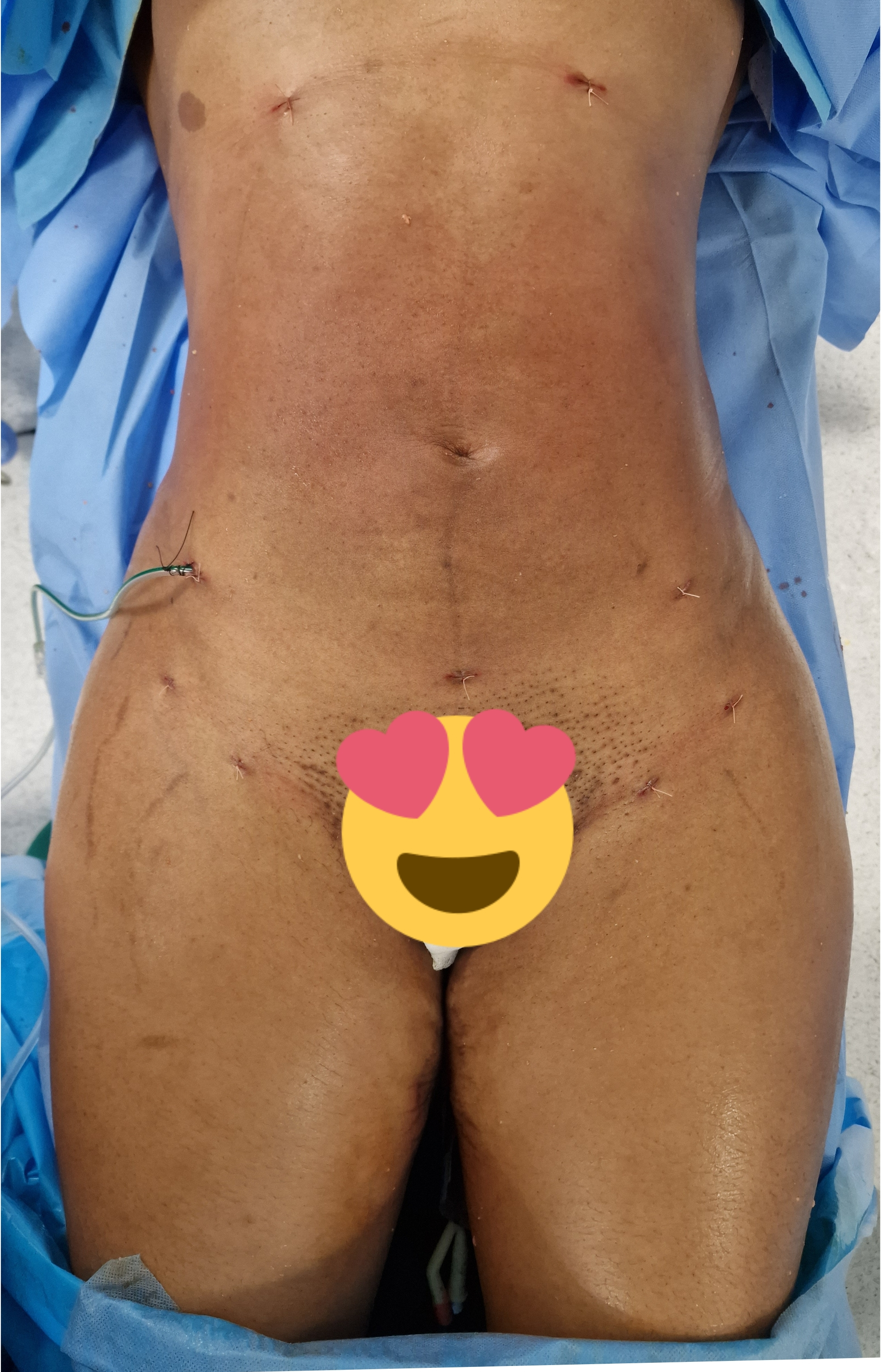 Dopo la liposuzione